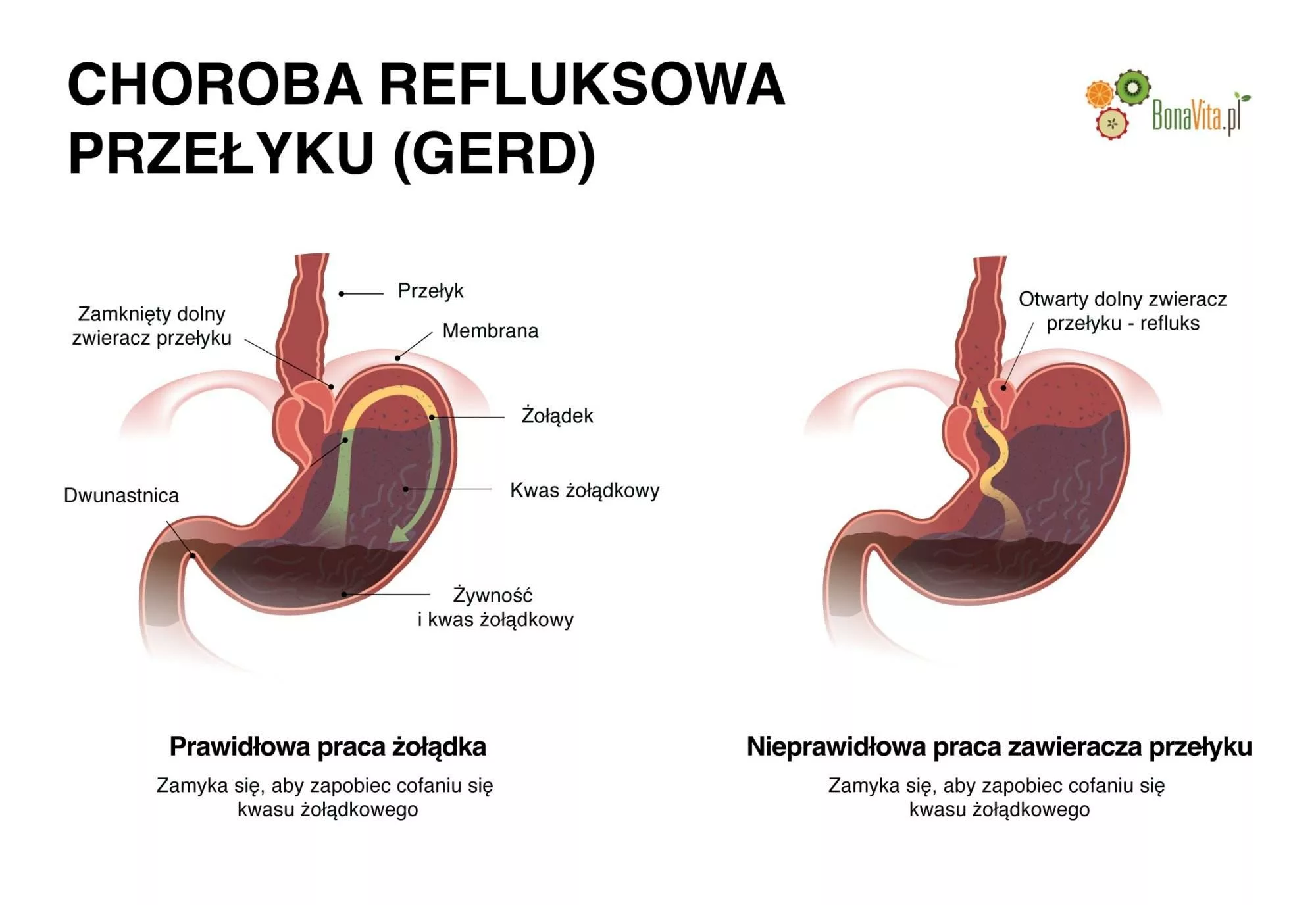 Domowe sposoby na refluks nie tylko zioła BonaVita Profesjonalny